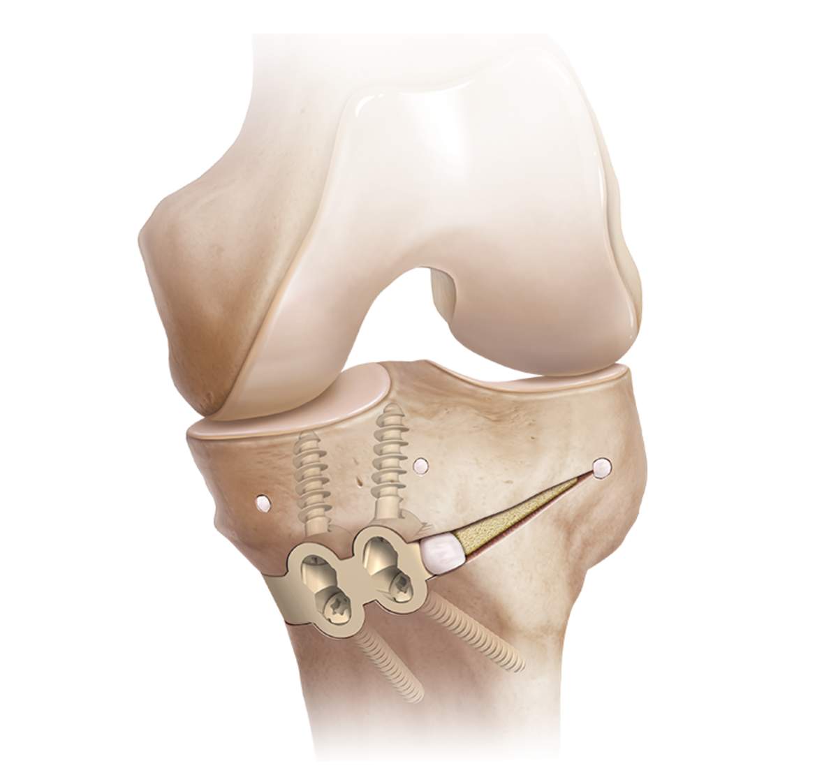 Knee Osteotomy アップデート osteotomy